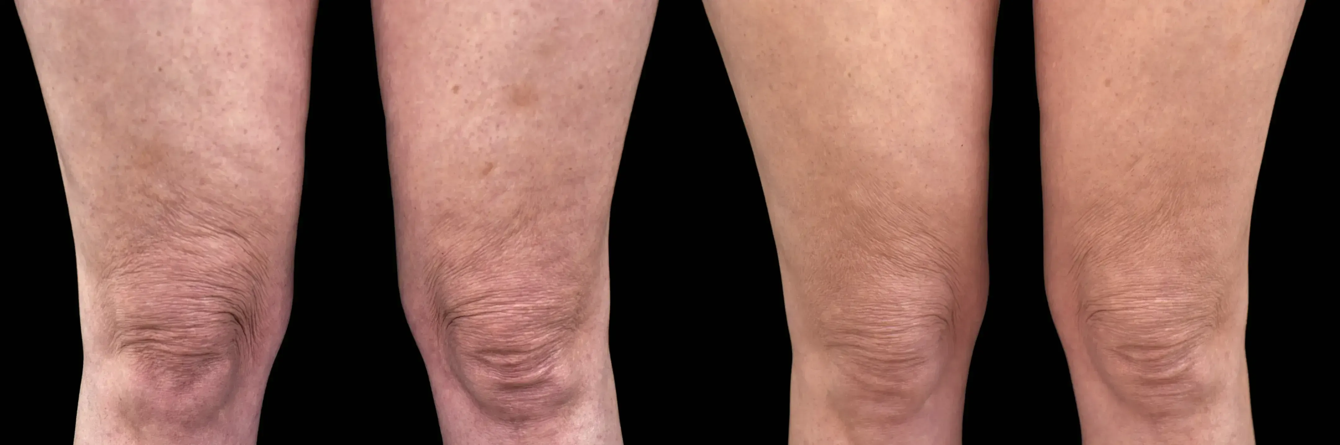 Emtone before and after