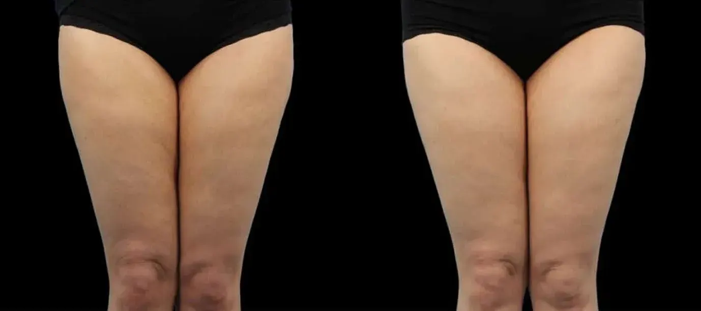 Emtone - Before and After