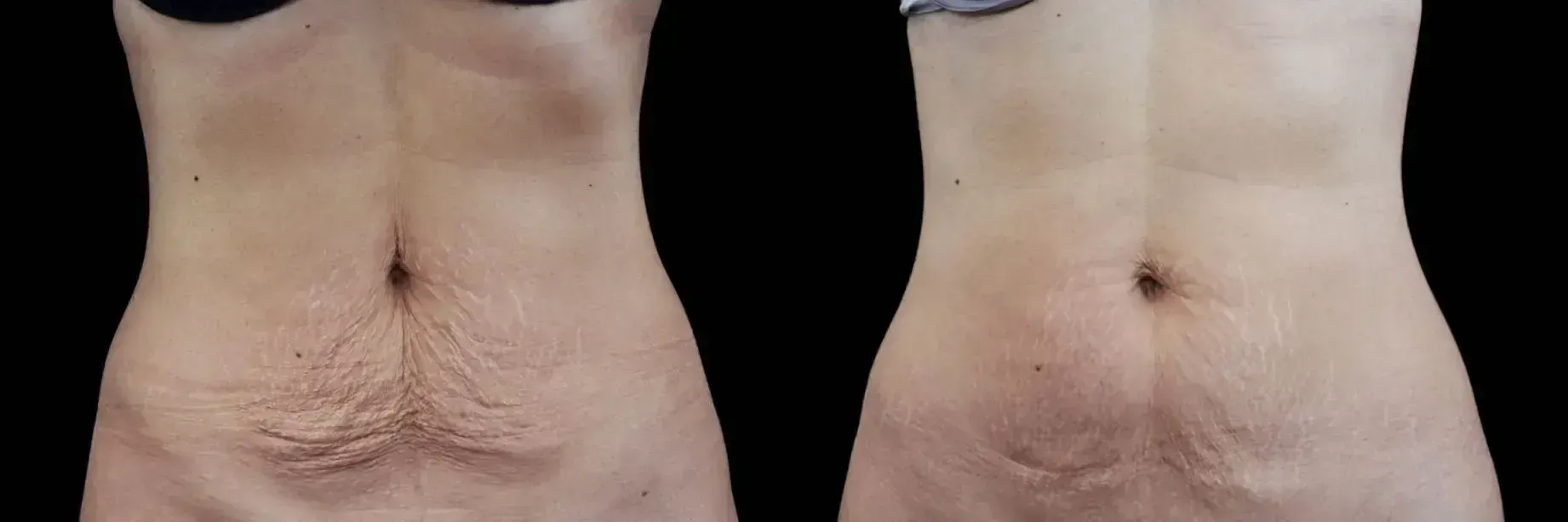 Emtone — Before and After