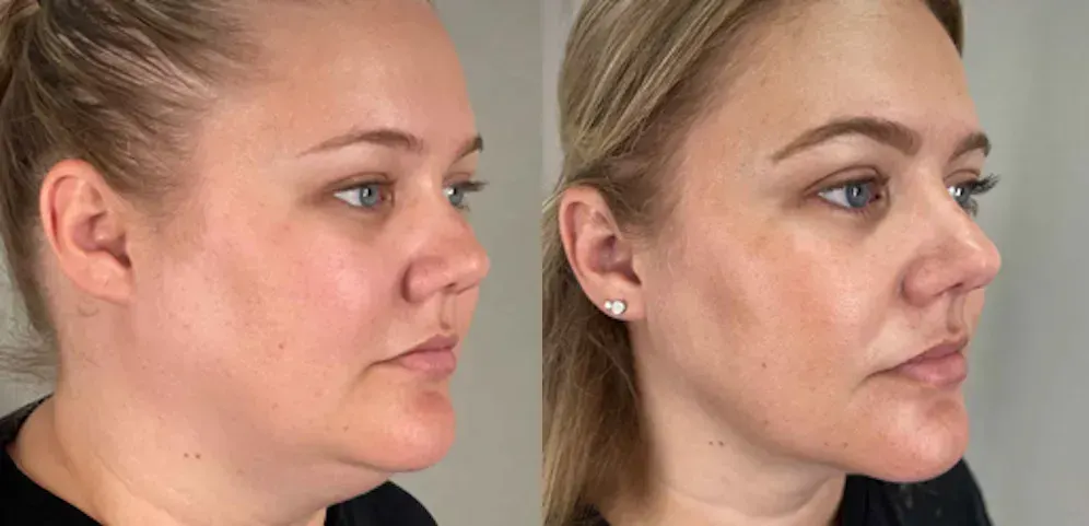 Semaglutide Weight Loss before and after