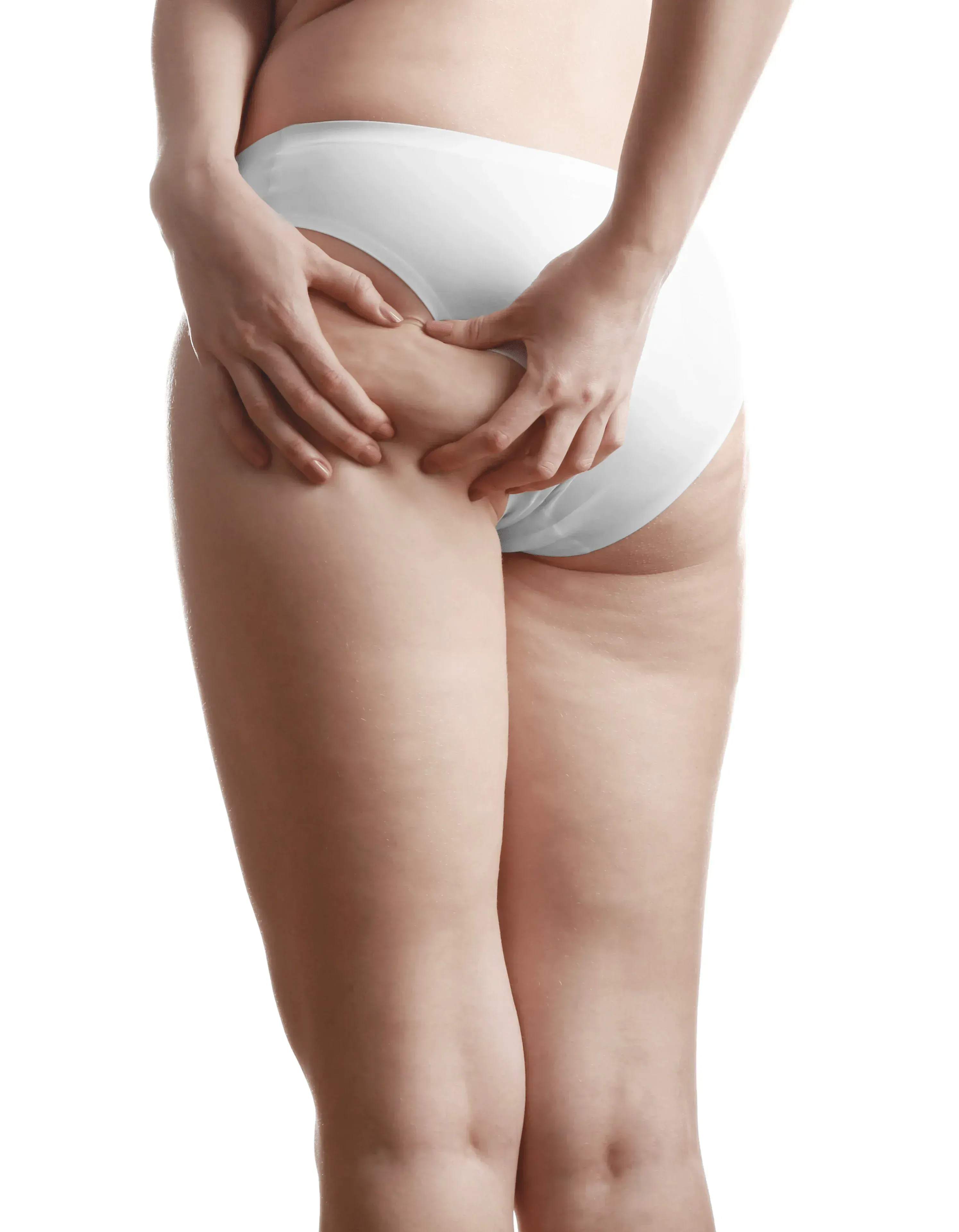 Illustration of cellulite formation in connective tissue at Riverstone Wellness Easley SC
