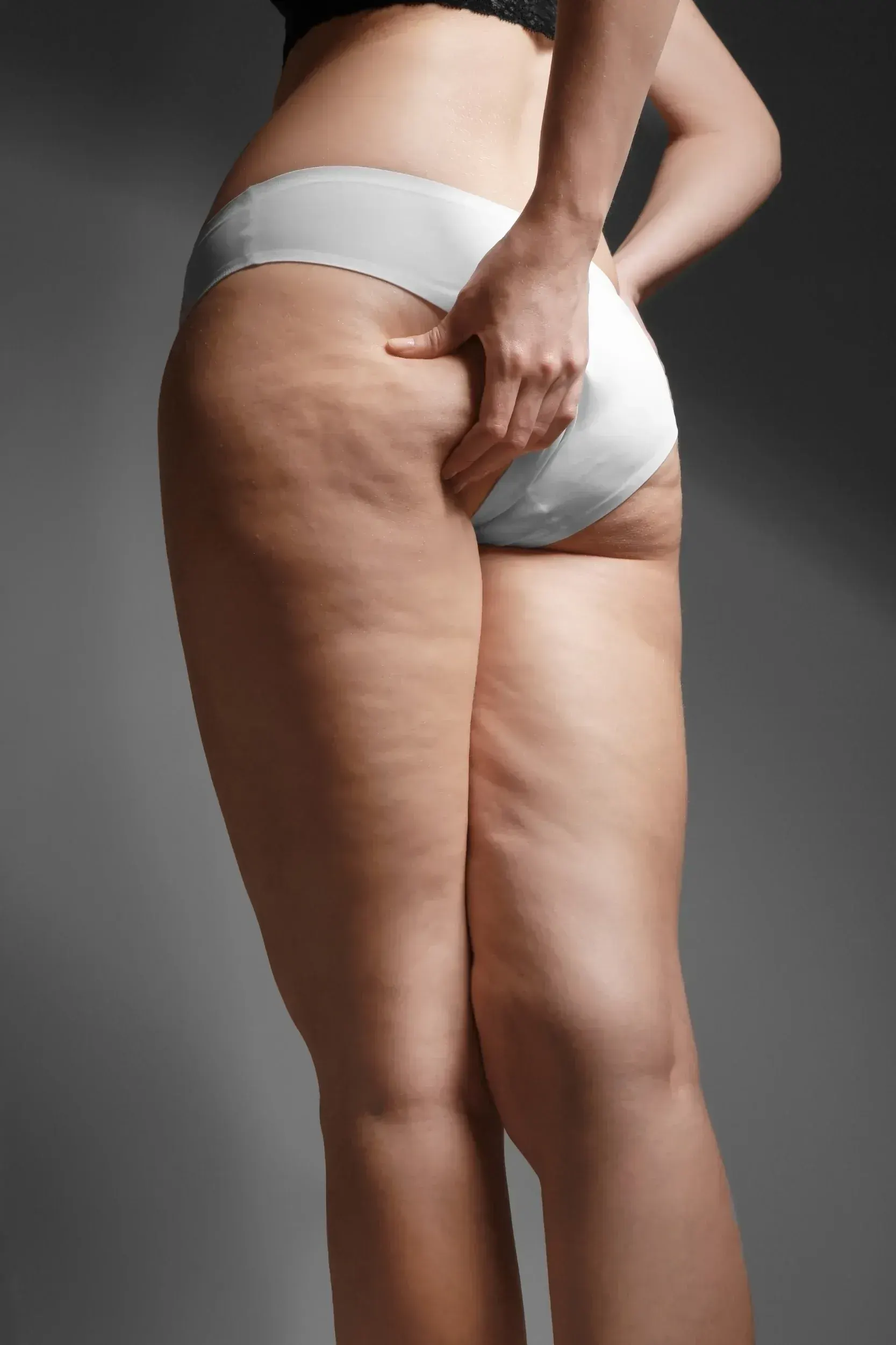 Woman considering cellulite treatment options at Riverstone Wellness Easley SC
